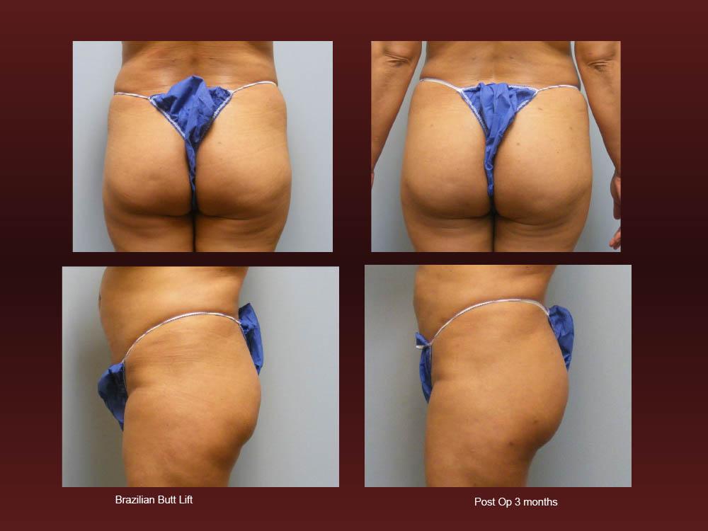 Before and After Photos - Brazillian Butt Lift (1)