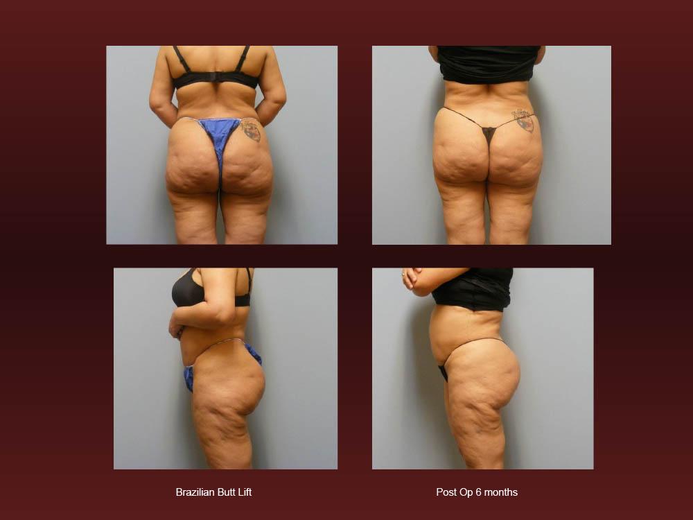 Before and After Photos - Brazillian Butt Lift (10)