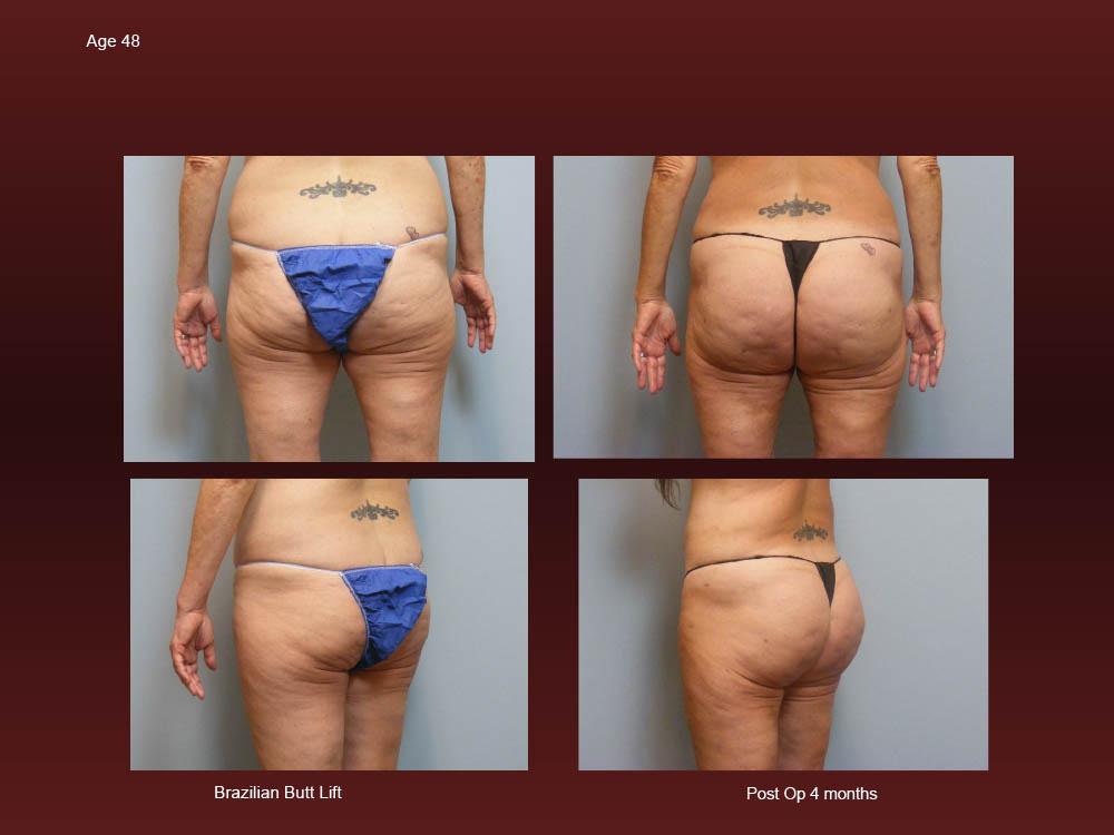 Before and After Photos - Brazillian Butt Lift (11)
