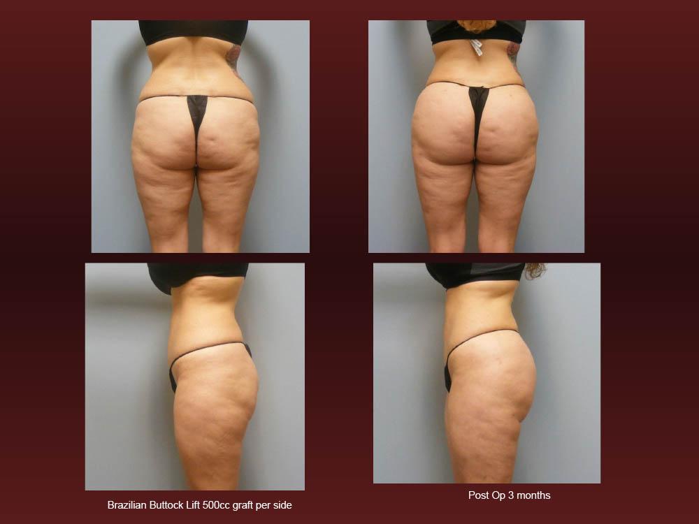 Before and After Photos - Brazillian Butt Lift (13)