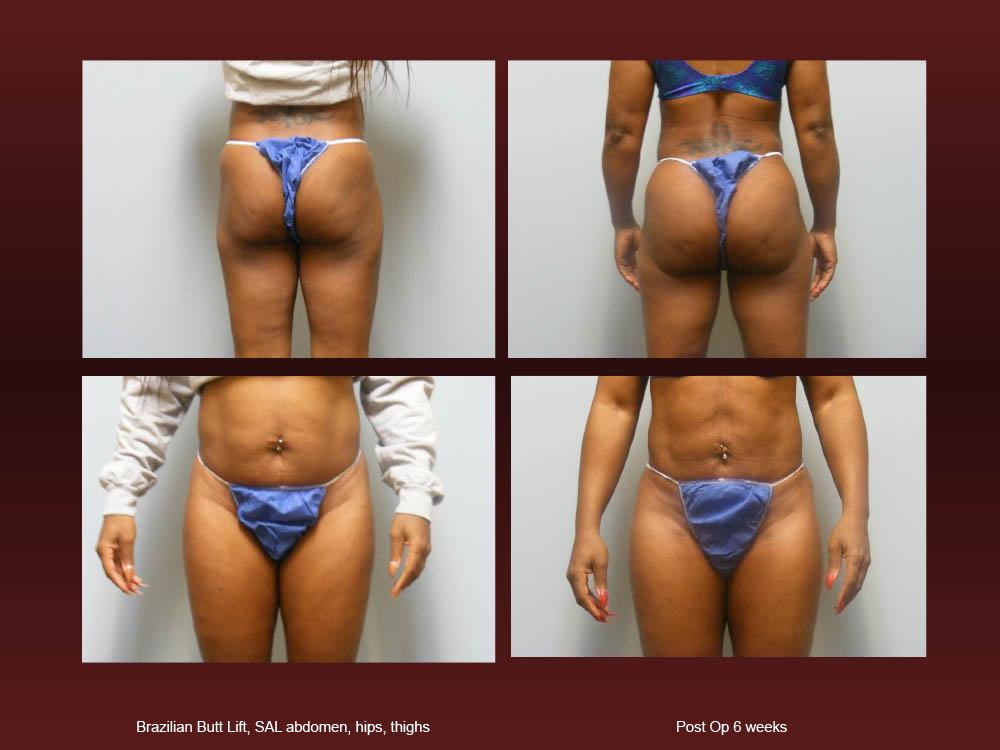 Before and After Photos - Brazillian Butt Lift (4)