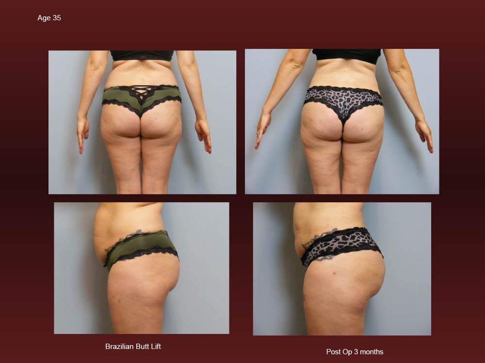 Before and After Photos - Brazillian Butt Lift (6)