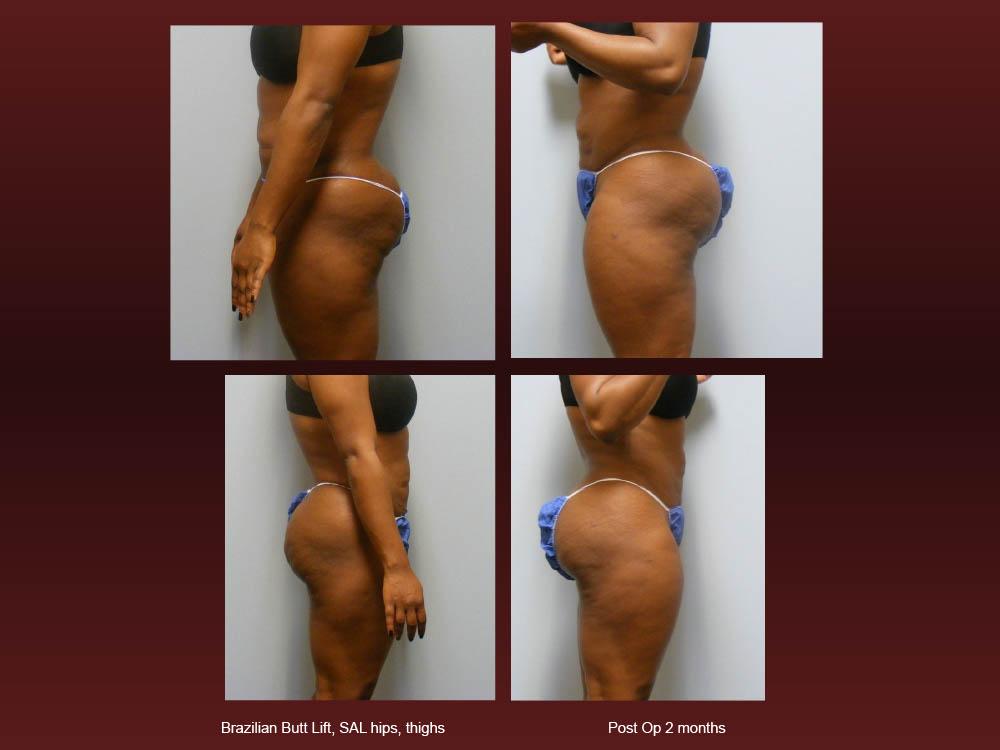 Before and After Photos - Brazillian Butt Lift (8)