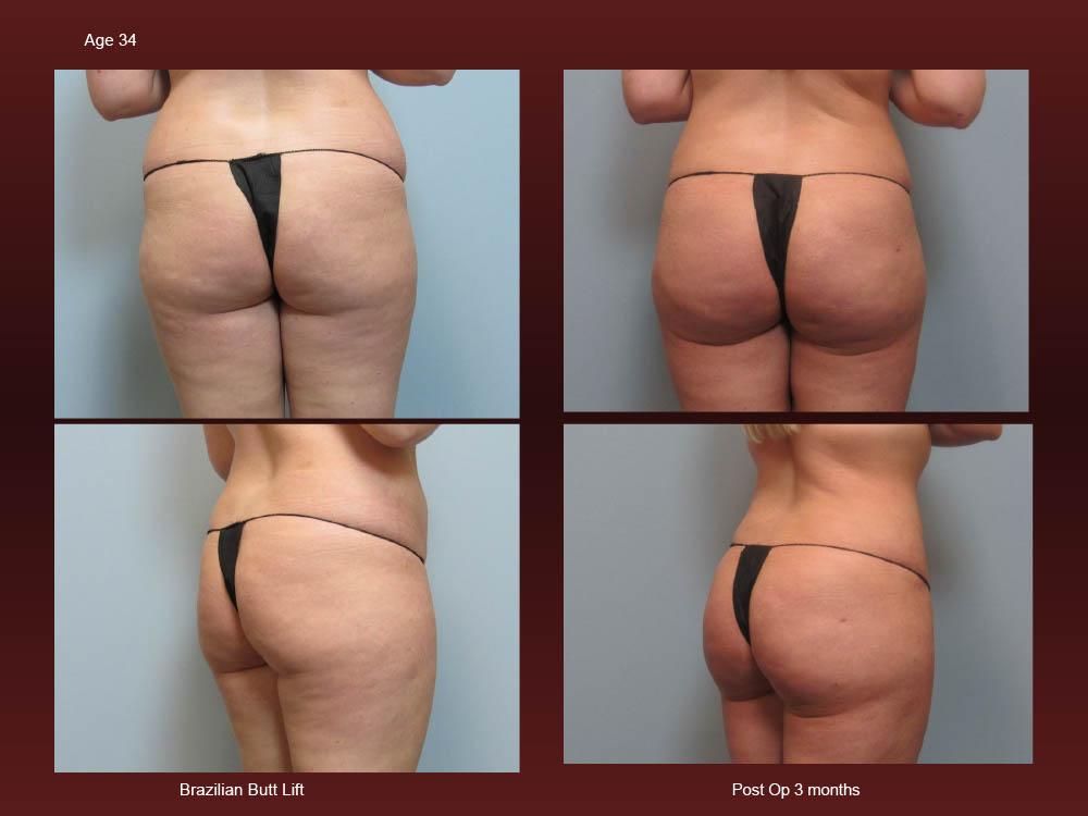 Before and After Photos - Brazillian Butt Lift (9)