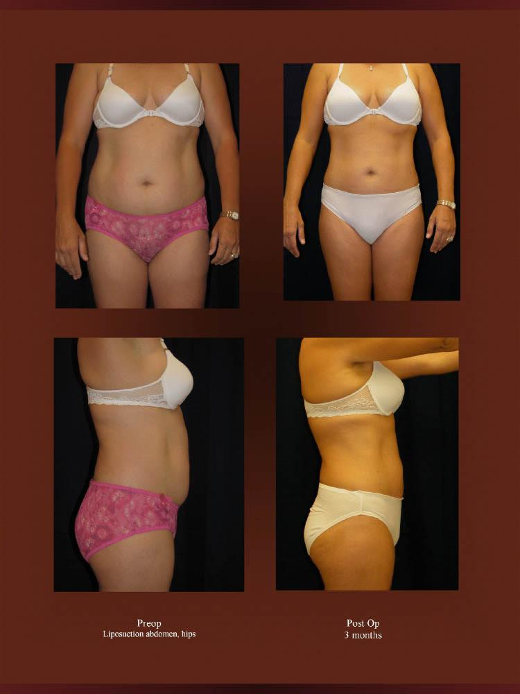 Before and After Photos - Liposuction (6)