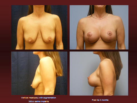 Breast lift with implants